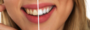 teeth whitening